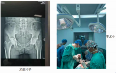 臨滄市中醫(yī)醫(yī)院外一科獨立成功完成人工陶瓷全髖關節(jié)置換手術